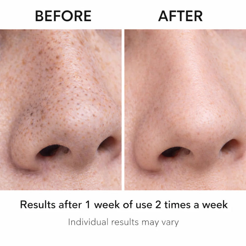 Acnixpia Blackhead Remover