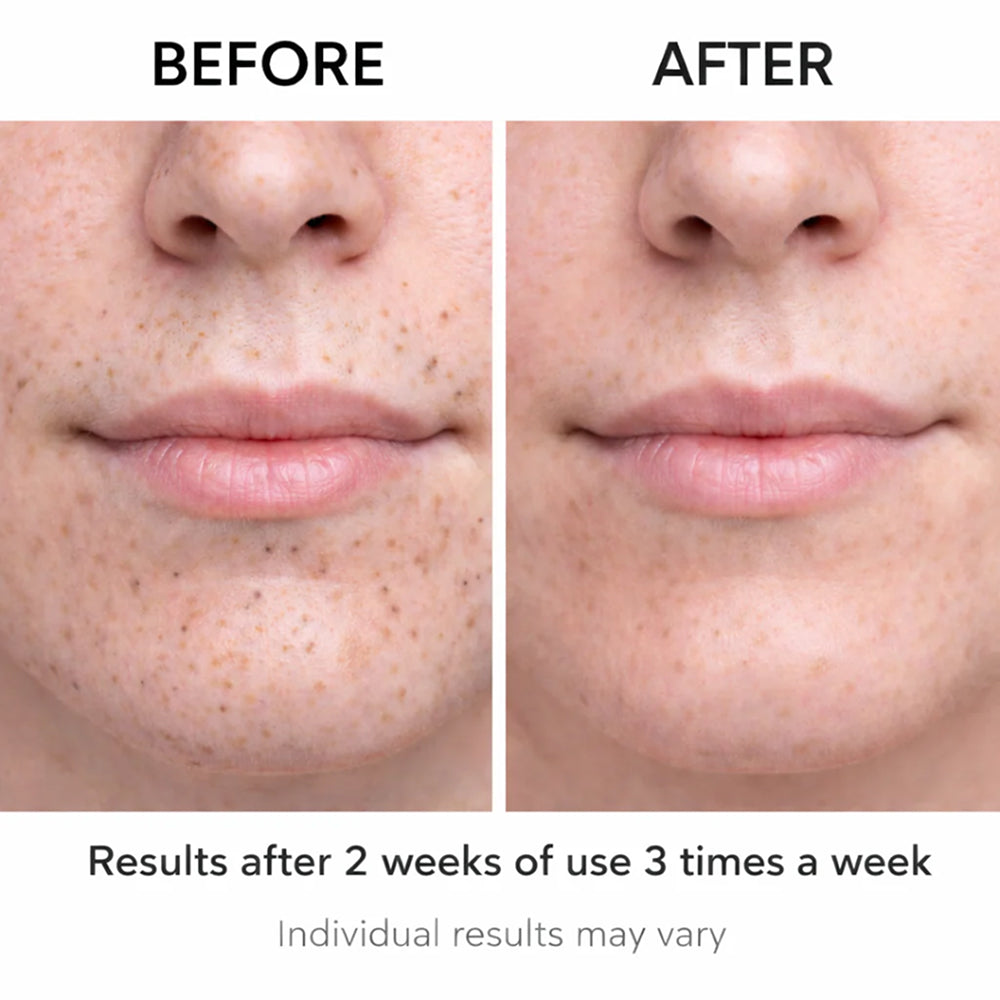 Acnixpia Blackhead Remover