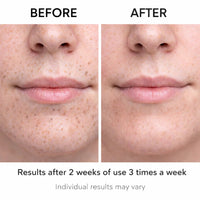 Acnixpia Blackhead Remover