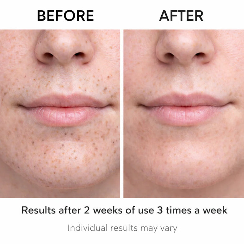 Acnixpia Blackhead Remover