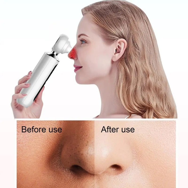 Acnixpia Blackhead Remover