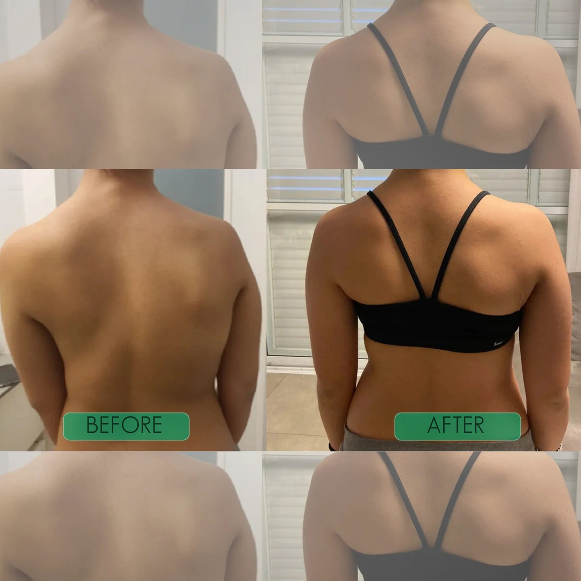 Postrixmer Back Brace Posture Corrector
