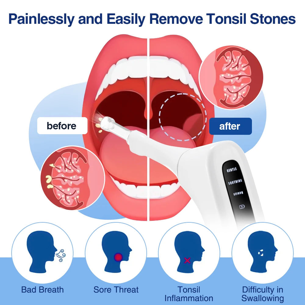Tonsimox Tonsil Stone Remover